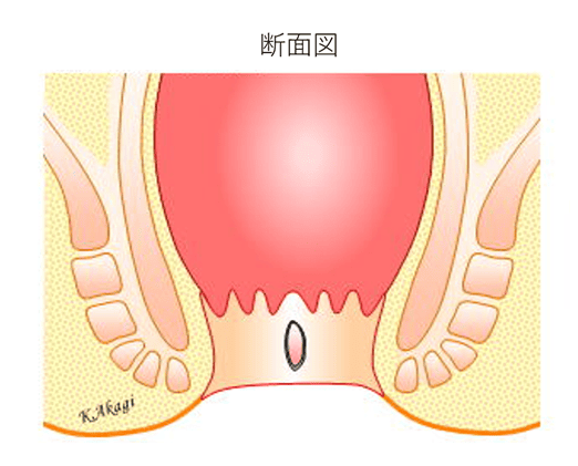 裂肛の様子断面