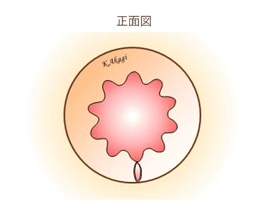裂肛の様子正面