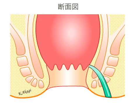 痔瘻　イメージ