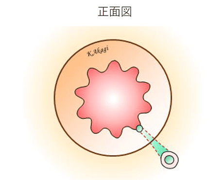痔瘻　イメージ