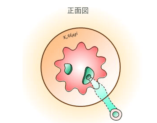 痔瘻　イメージ