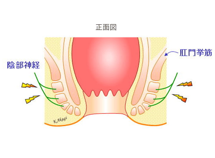 裂肛の様子断面