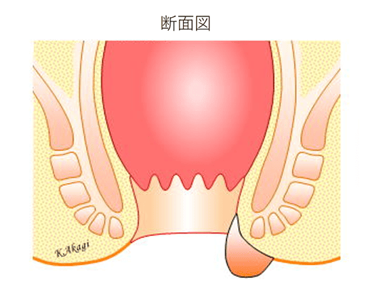 内痔核の様子断面