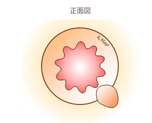 内痔核の様子正面