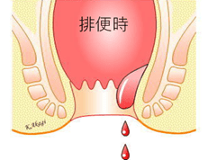 内痔核Ⅰ度の模式図