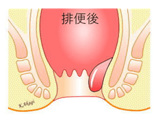 内痔核Ⅱ度の模式図