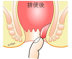 内痔核Ⅲ度の模式図