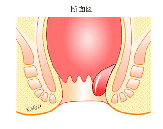 内痔核の様子断面