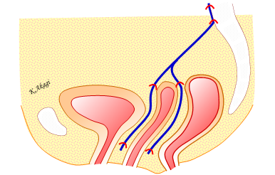メッシュで腟を支えて仙骨に固定するイメージ図