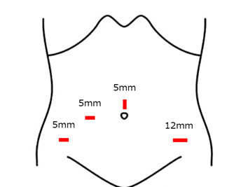 腹腔鏡で骨盤内を確認するイメージ図